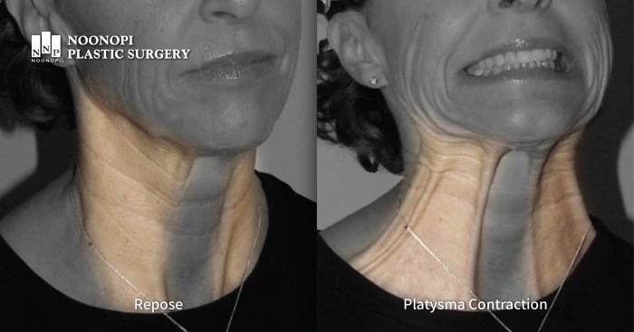 Principle of corset platysmaplasty and mini neck lift effect