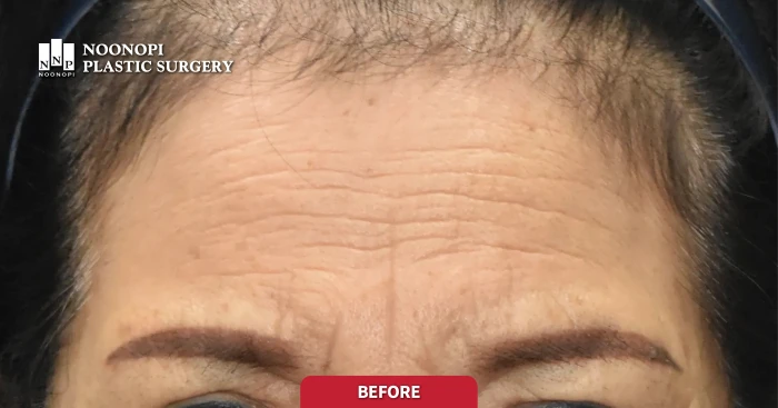 이마주름이 심한 사례