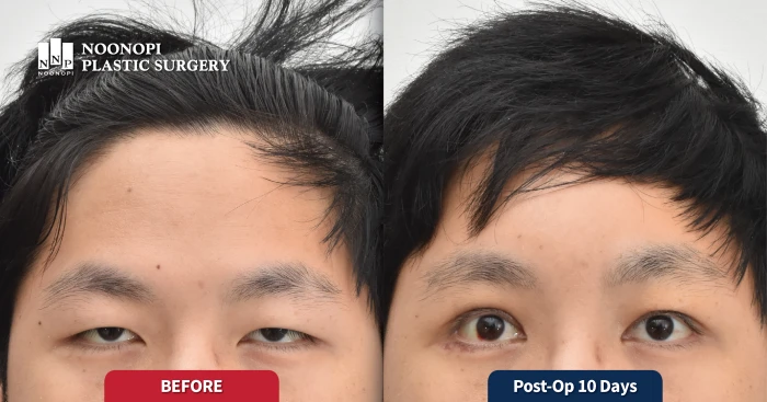 눈 위가 두툼하여 눈썹거상이 도움되는 경우