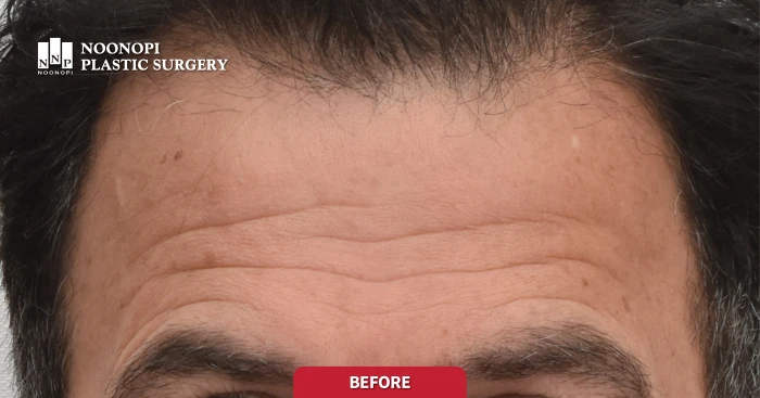 60대 남성 깊은 이마주름 수술 전