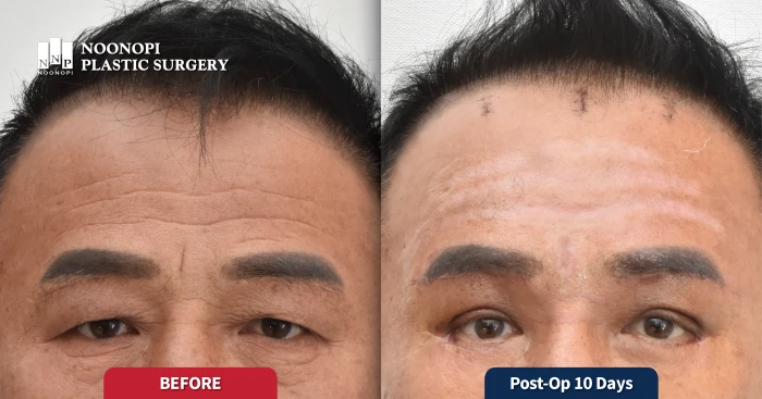 눈썹거상과  레이저 박피 동시시행후 매끈해진 이마