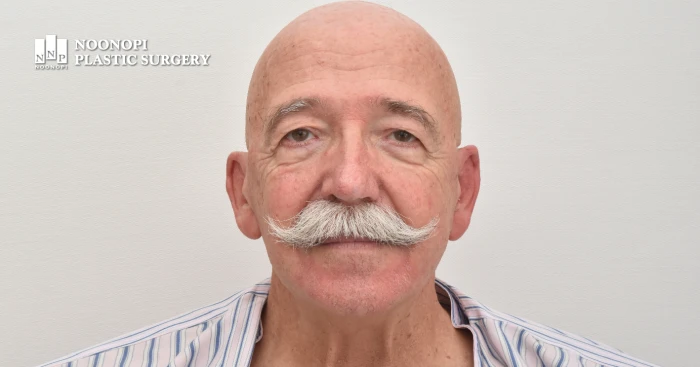 안면거상흉터를 숨기기 힘든 대머리 탈모인의 전후 사례를 소개합니다