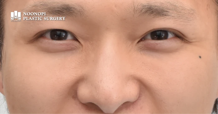 자연스러운 애교살 지방이식