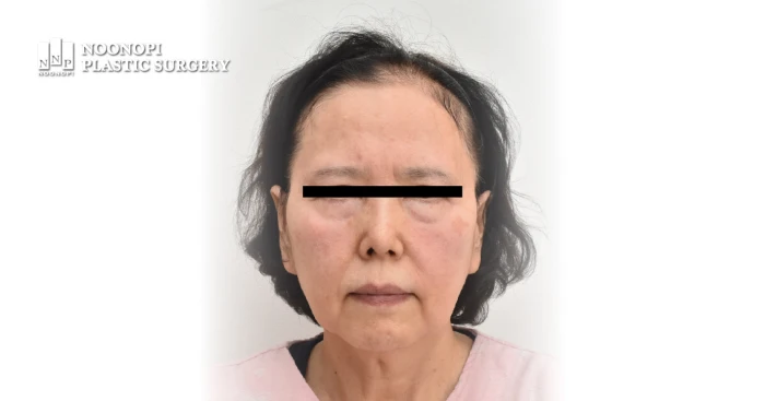 얼굴 주름과 처짐, 볼륨 꺼짐이 동반된 안면거상술 전 모습