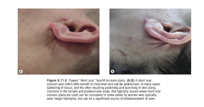 짧은 흉터 미니거상의 부작용인 피부 뭉침 현상
