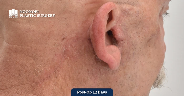 눈높이성형외과 대머리 남성 안면거상: 귀 뒤 절개선에 당겨진 피부가 뭉침 없이 점진적으로 봉합된 모습