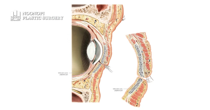 For Aegyo-sal fat grafting, the fat is precisely injected above the pretarsal portion of the orbicularis oculi muscle