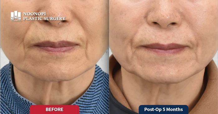 프락셀 레이저를 통한 피부결 개선 효과