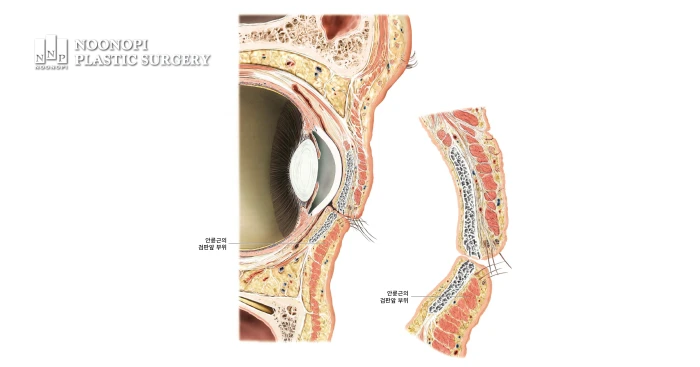 애교살지방이식에서 지방 주입 위치
