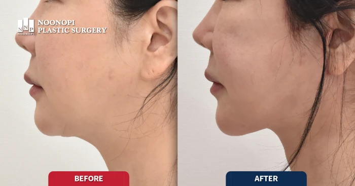 안면거상술과 목거상술 턱선 리프팅 전후