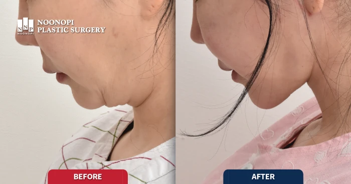 목거상술과 이중턱 제거 전후 모습