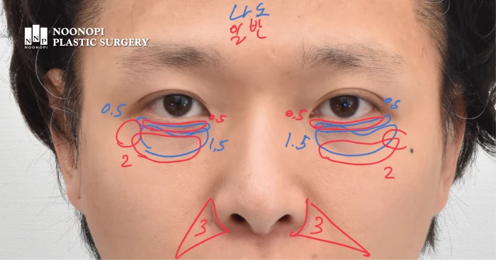 눈높이성형외과 애교지방이식 수술 노하우