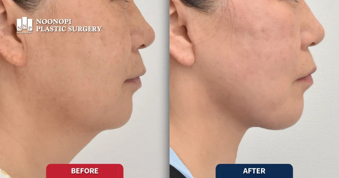 안면거상 전후 모습