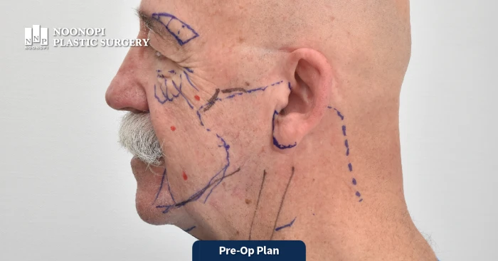 대머리 안면거상 절개선 위치 선정