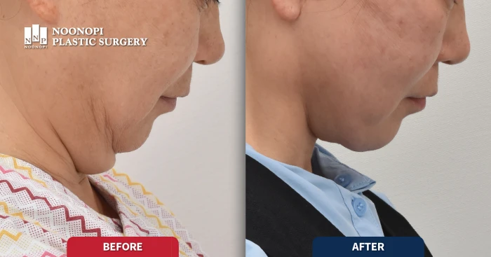 이중턱 근육묶기 전후