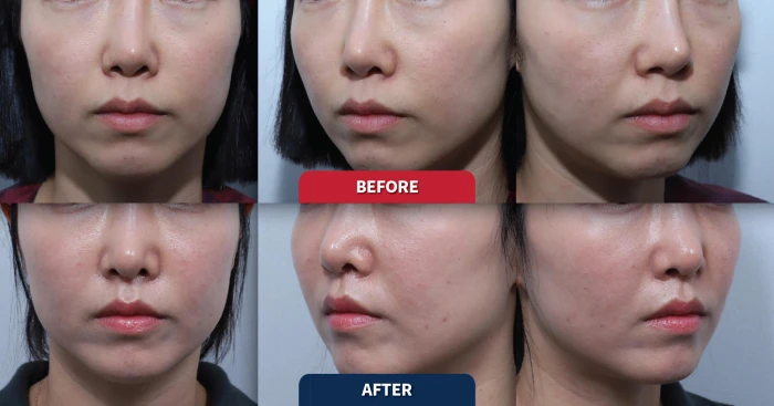 풀페이스 지방이식을 통한 얼굴 볼륨 회복 전후