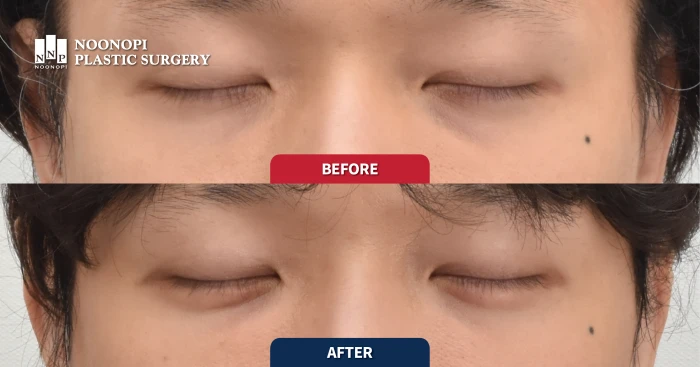 눈밑지방재배치와 애교 지방이식 전후