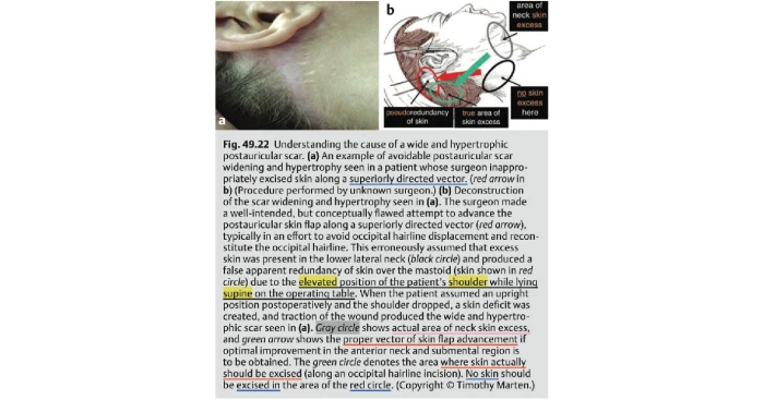 안면거상 귀 뒤 절개선의 역할을 설명한 교과서 내용