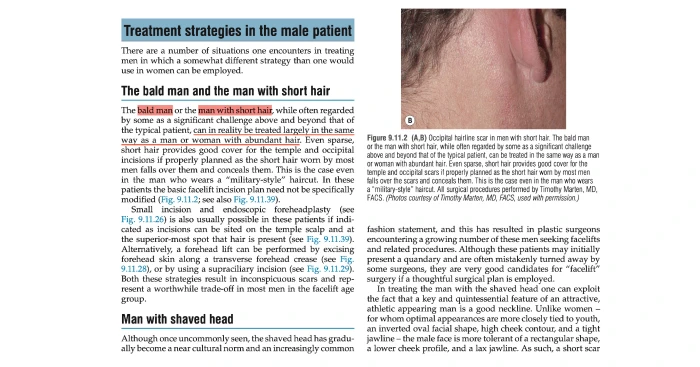대머리에서도 절개가 충분히 길어야 한다는 Nelligan 교과서의 인용 문장을 설명한 사진