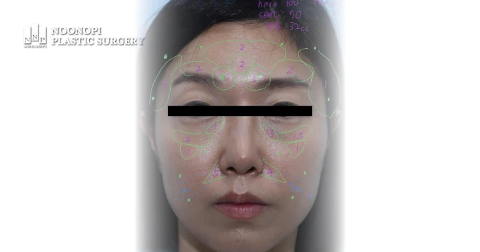 지방이식 주입량