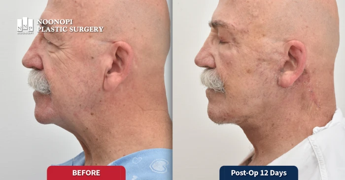 남성안면거상 후기