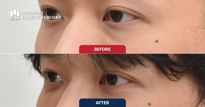 애교살 지방이식 전후