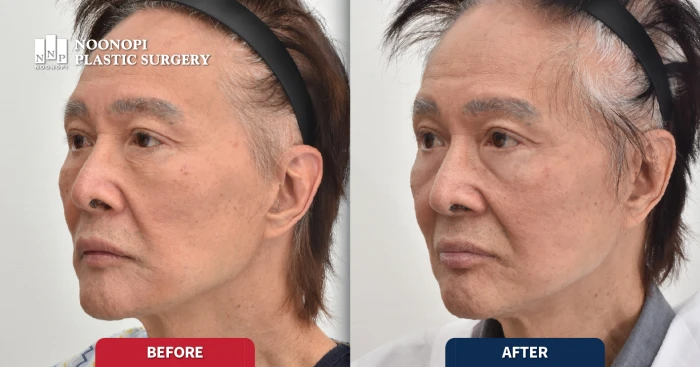 laser skin resurfacing before after