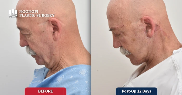 눈높이성형외과 목거상 전후 사례