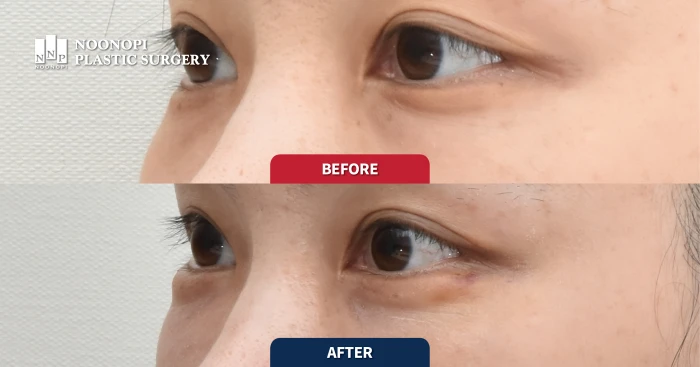 애교 지방이식 전후 사진