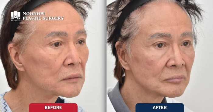 피부 레이저 박피 전후