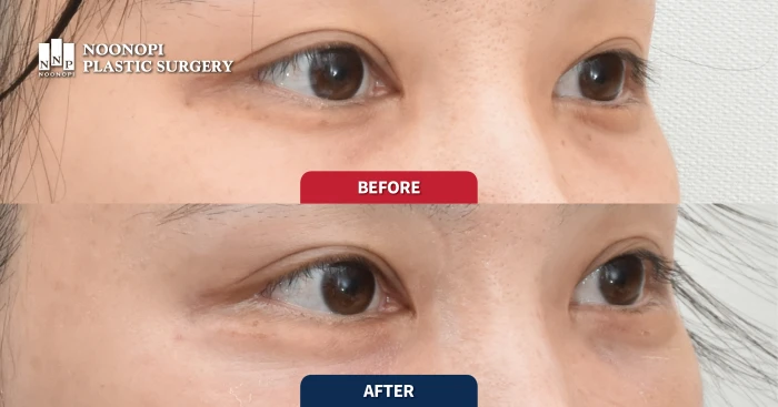 애교필러 대신 애교살 지방이식 전후 모습