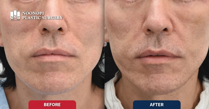 거상 후 꺼진 볼륨을 얼굴 지방이식으로 교정한 사례