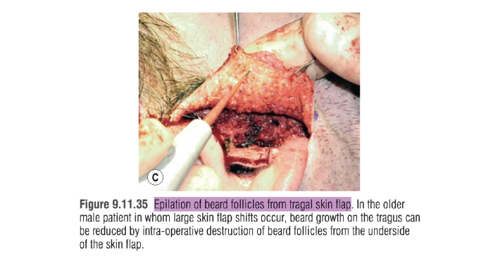 남성 안면거상 제모 방법