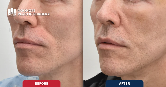 중안면 지방이식