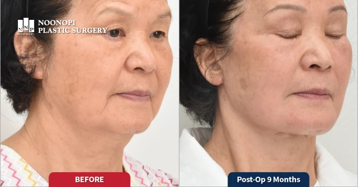 안면거상 9개월 후 모습