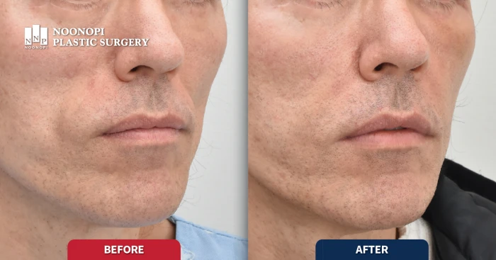 팔자 지방이식 전후