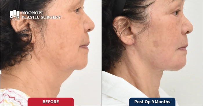 안면거상술 전후 9개월 후 모습