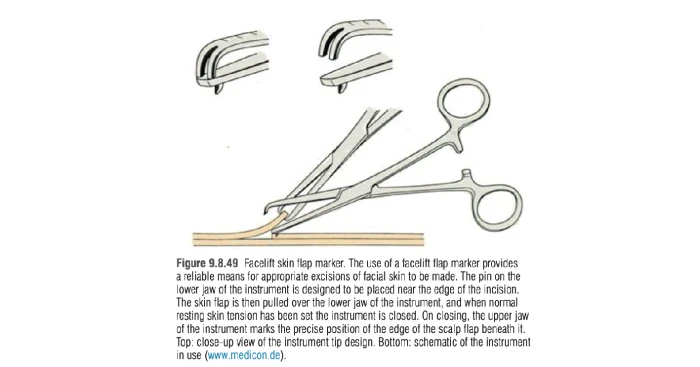 안면거상술에서 여분의 피부를 측정하는 특후 기구의 모습, 페이스리프트 마커(facelift marker) 