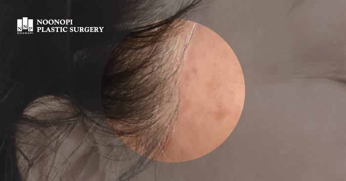 안면거상 흉터 자세히 클로즈업 한 사진