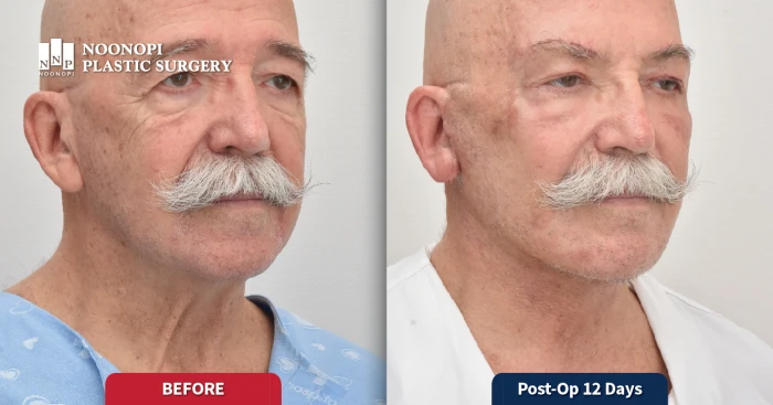 눈높이 안면거상 후기