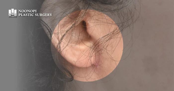 안면거상술 흉터 클로즈업 모습