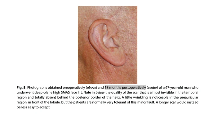 귀앞절개 안면거상 흉터