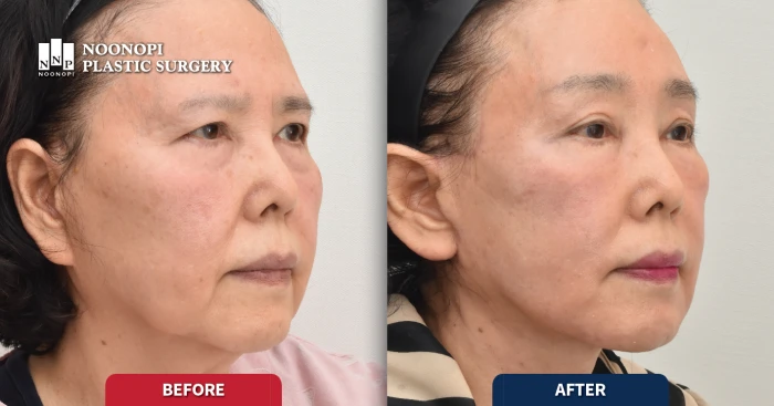 프락셀레이저와 안면거상 재수술과 얼굴 지방이식  동시 시행한 전후 사진