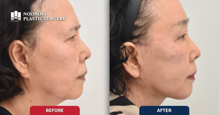 안면거상 재수술 후기