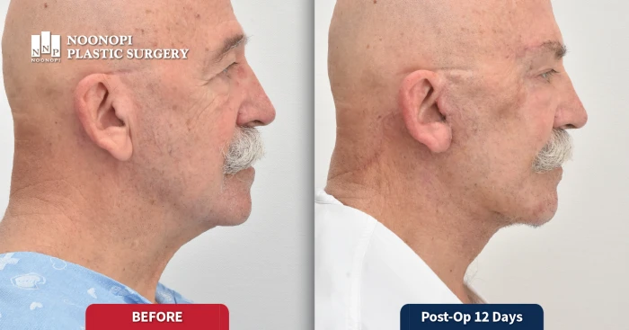 눈높이성형외과 안면거상술 후기