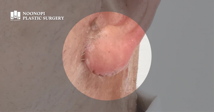 안면거상 칼귀교정 전후