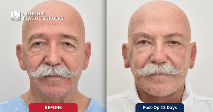 안면거상 지방이식 레이저 전후 사례