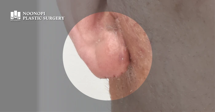 안면거상술 칼귀교정 후기