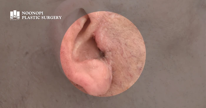 이주뒤 절개 사진