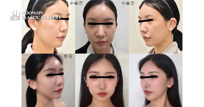 안면거상전후 결과 판단할 때 화장 및 조명 속임수 주의